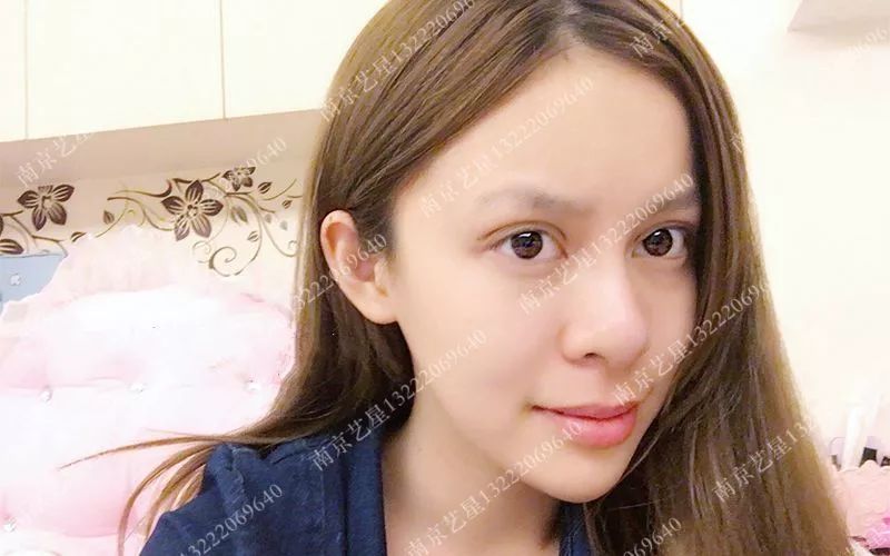 南京艺星汪树杰做的6mm双眼皮,来围观效果吧