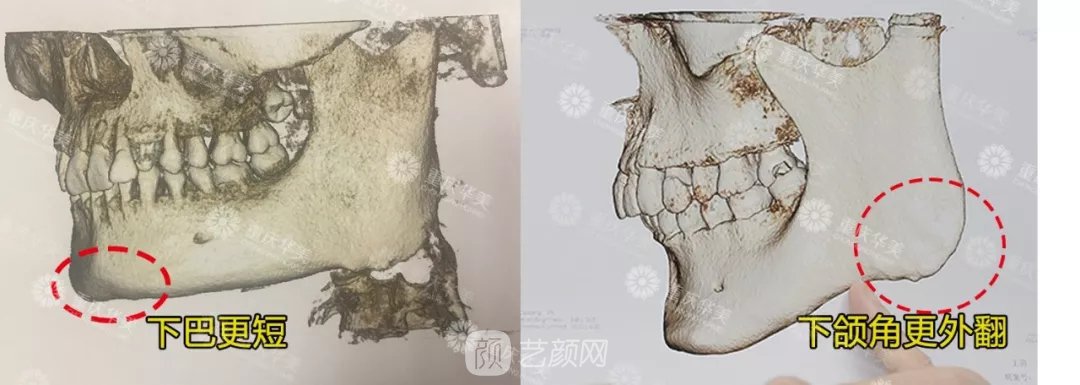 但明显右侧这位求美者的下颌角外翻和突出更明显.