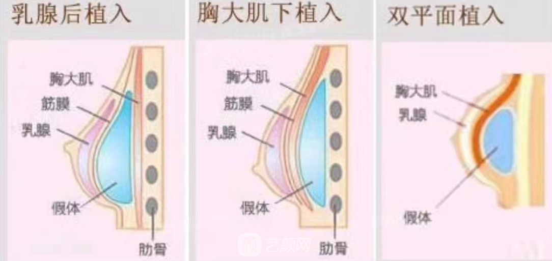 乳房假体使用寿命有哪些呢?