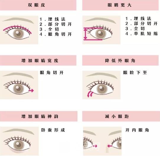 日本双眼皮手术案例图宛若天生 双眼皮修炼手册