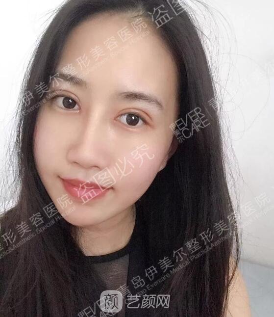 双眼皮术后7天效果图
