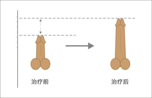 阴茎延长