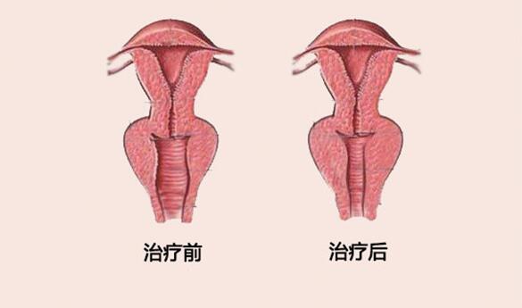 阴道紧缩