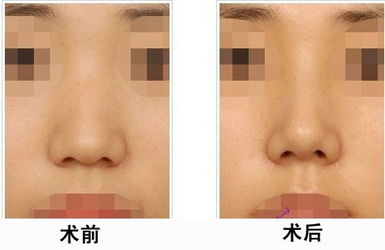人中加深