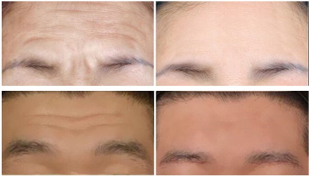 自体脂肪去抬头纹