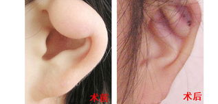 小耳畸形矫正