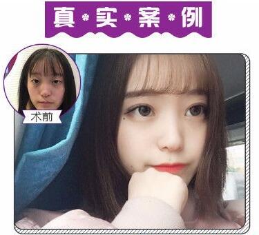 苏州美莱张亮做的双眼皮案例