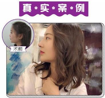 苏州美莱尹飞做的鼻部手术隆鼻案例