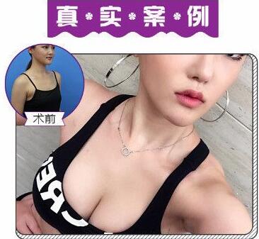 苏州美莱李永峰做的假体隆胸案例