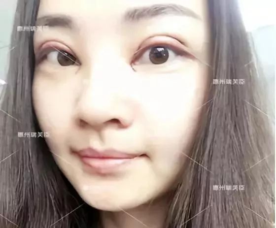 惠州瑞芙臣刘丹虹双眼皮+开眼角整形日记~