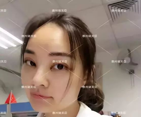 惠州瑞芙臣刘丹虹双眼皮+开眼角整形日记~