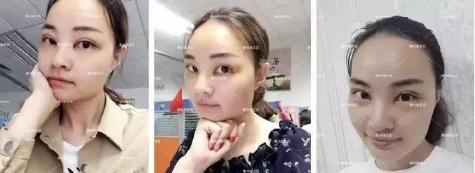 惠州瑞芙臣刘丹虹双眼皮+开眼角整形日记~