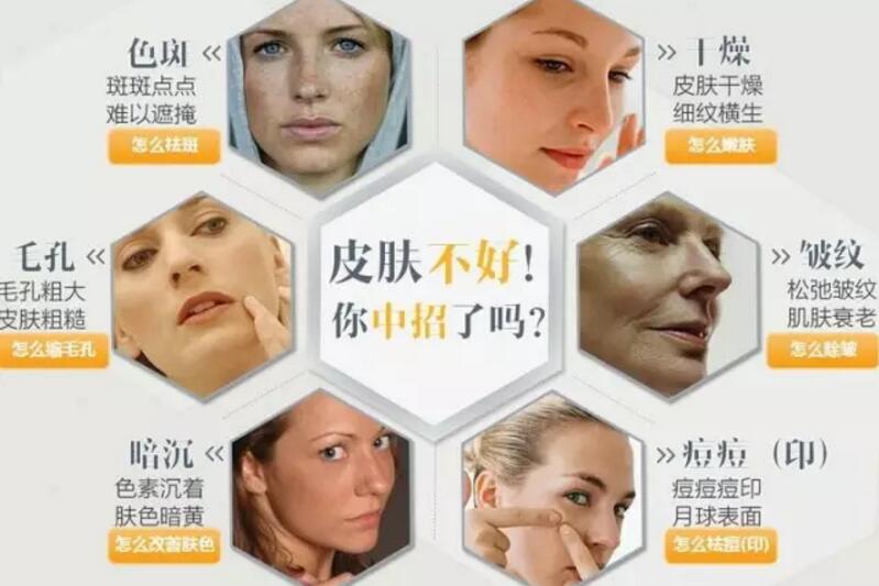 光子嫩肤