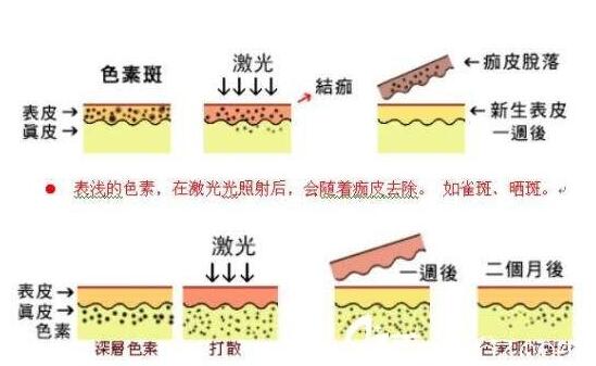 光子嫩肤
