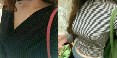 【曼托妙桃400cc水滴形假体隆胸日记——等你等得好辛苦~】