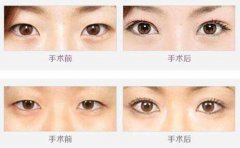 韩式微创翘睫毛双眼皮