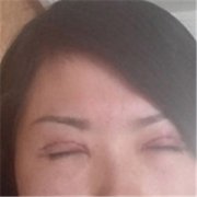 开眼角1个月恢复过程图，西安美立方李蓉华做的~