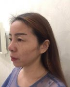 厦门莫琳娜埋线提升提升图以及恢复过程分享~