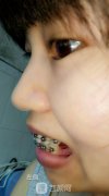 李宇牙齿矫正恢复图手册