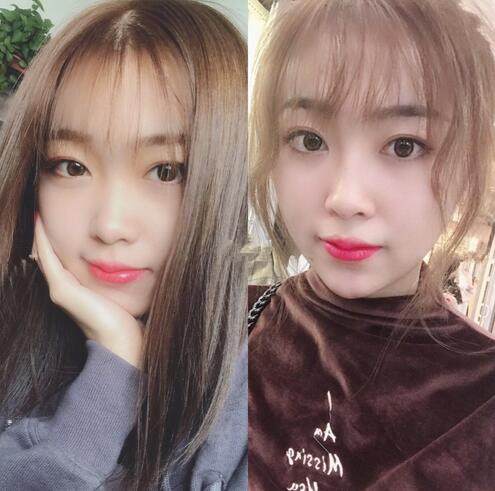 玻尿酸丰唇需要多少钱？玻尿酸丰唇术后恢复心得