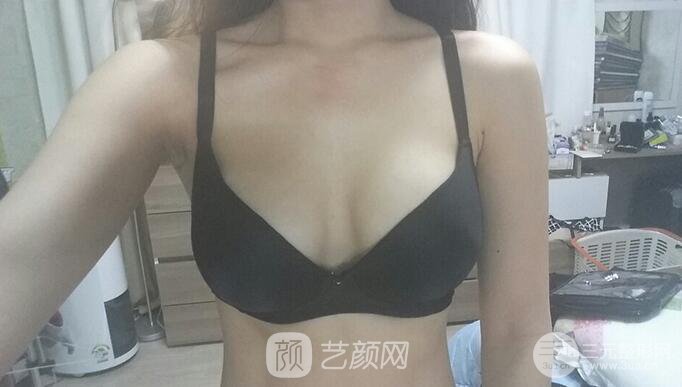 北京隆胸抽脂多少钱?北京东方和谐自体脂肪丰胸案例