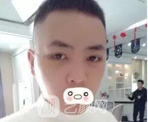 爱思特张姣姣双眼皮案例照片日记 男生也会做双眼皮手术哦
