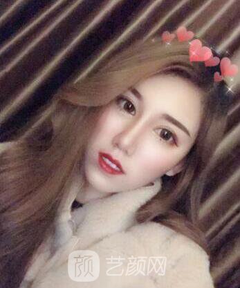 隆鼻案例照片