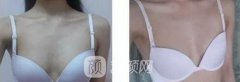 深圳非凡杨伟杰假体隆胸案例分享!
