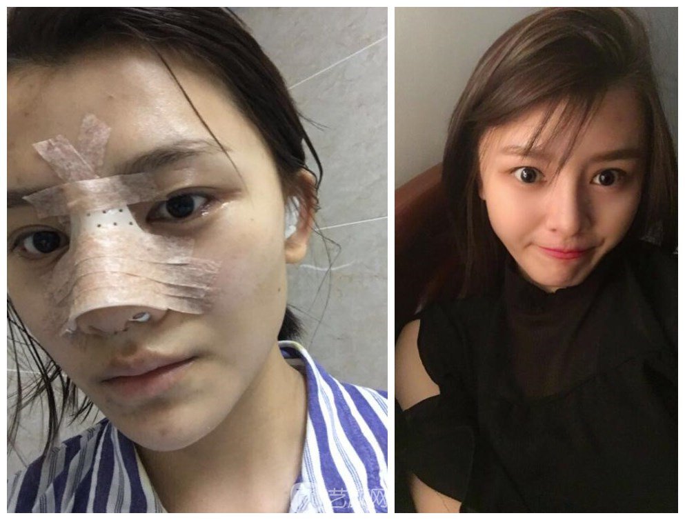上海伊美尔港华医院整形案例图