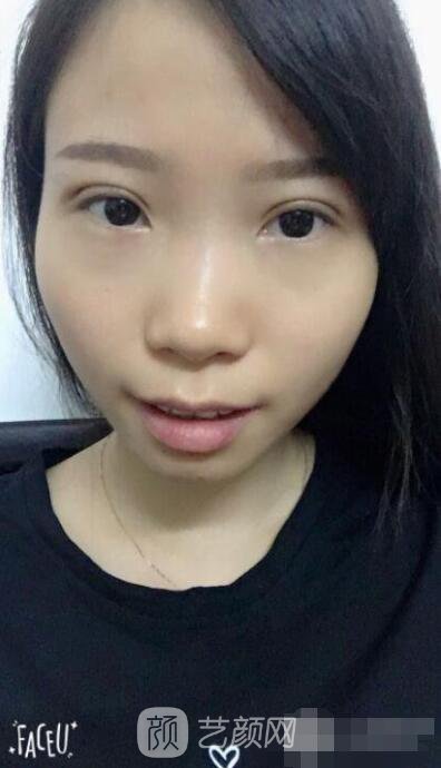 庄璐全切双眼皮照 全过程恢复经验之谈