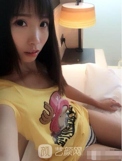 庄璐全切双眼皮照 全过程恢复经验之谈