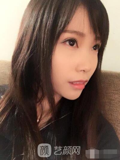 庄璐全切双眼皮照 全过程恢复经验之谈