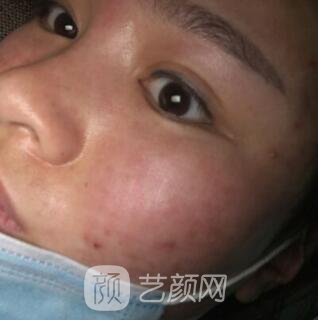 福州比华利林秋蓉激光祛痘图 满脸痘痘到光滑肌肤