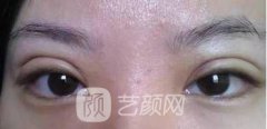 双眼皮割宽了，还能变窄吗？