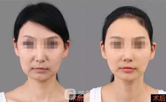 重庆当代整形医院自体脂肪填充照真人案例