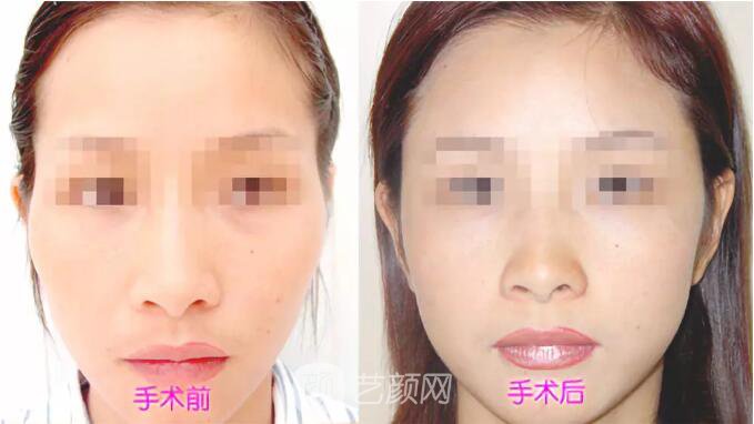重庆当代整形医院自体脂肪填充照真人案例