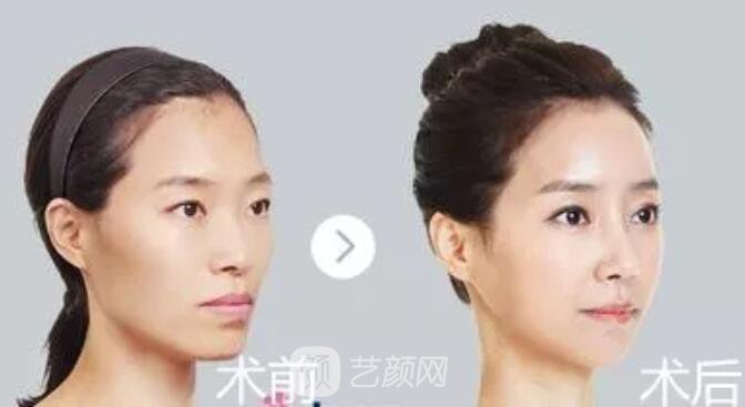 重庆当代整形医院自体脂肪填充照真人案例