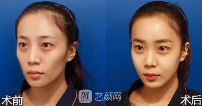重庆当代整形医院自体脂肪填充照真人案例