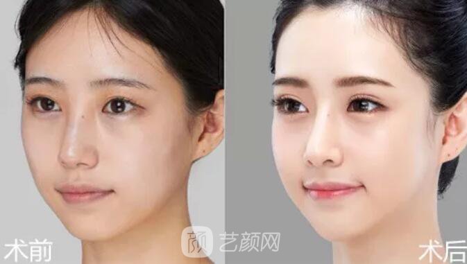 重庆当代整形医院自体脂肪填充照真人案例