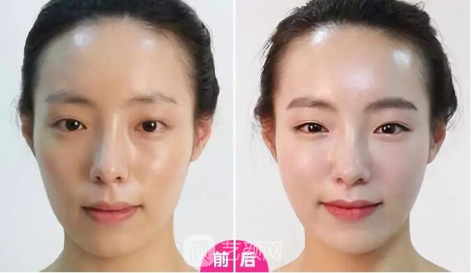 重庆当代整形医院自体脂肪填充照真人案例