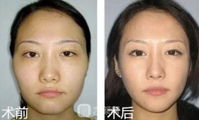 重庆当代整形医院自体脂肪填充照真人案例