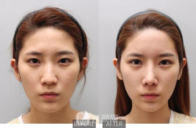 重庆当代整形医院自体脂肪填充照真人案例