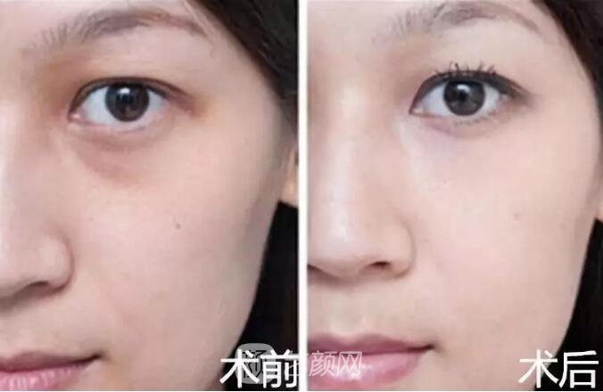 重庆当代整形医院自体脂肪填充照真人案例