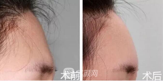 重庆当代整形医院自体脂肪填充照真人案例
