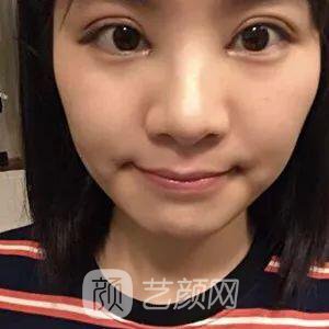西安碑林西美王艳娜双眼皮图 真实案例心情分享