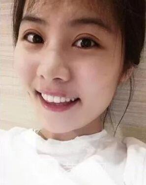 西安碑林西美王艳娜双眼皮图 真实案例心情分享