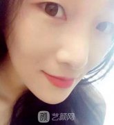 烟台鹏爱医疗美容医院切开双眼皮案例分享~