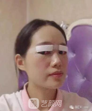 王红敏切开双眼皮+开内眼角图术后心情小述