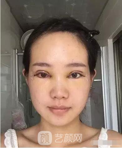 王红敏切开双眼皮+开内眼角图术后心情小述