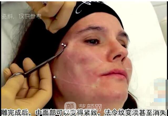 别再为法令纹犯愁了，用这两种方法摆平它